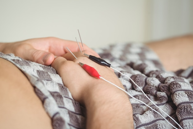 Dry needling trigger point therapy